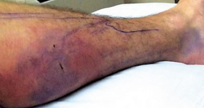 Rattlesnake Bite on Leg